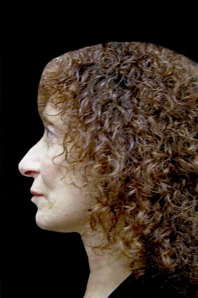Neck Lift Before & After Patient #2664
