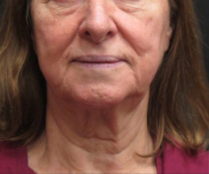 Neck Lift Before & After Patient #2675