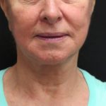Neck Lift Before & After Patient #2675