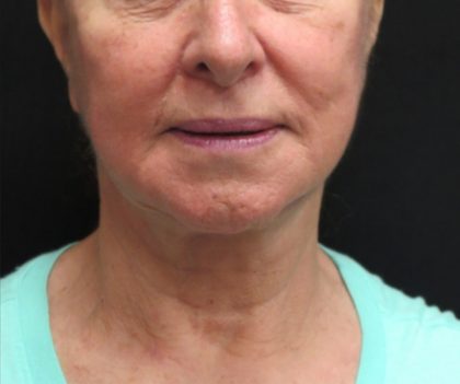 Neck Lift Before & After Patient #2675