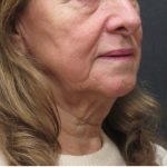 Neck Lift Before & After Patient #2675