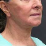Neck Lift Before & After Patient #2675