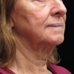 Neck Lift Before & After Patient #2675