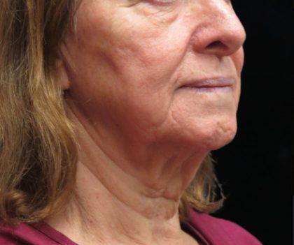 Neck Lift Before & After Patient #2675