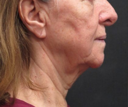 Neck Lift Before & After Patient #2675