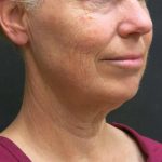 Neck Lift Before & After Patient #2697