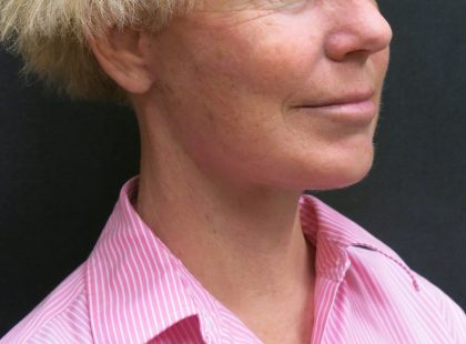 Neck Lift Before & After Patient #2697