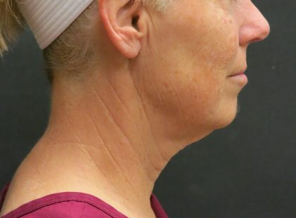 Neck Lift Before & After Patient #2697