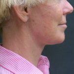Neck Lift Before & After Patient #2697