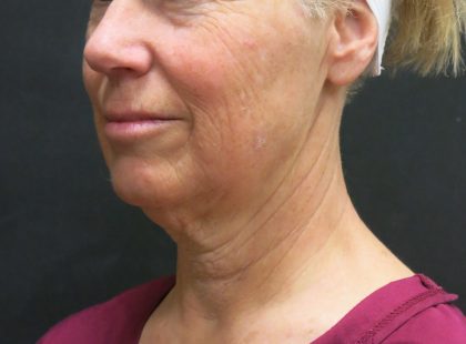 Neck Lift Before & After Patient #2697