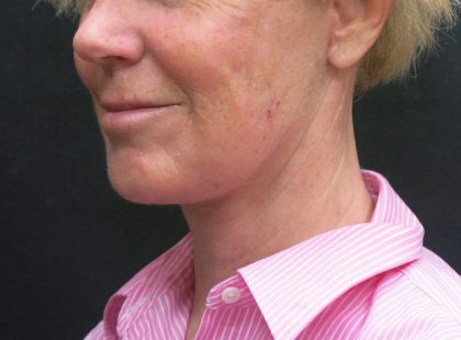 Neck Lift Before & After Patient #2697