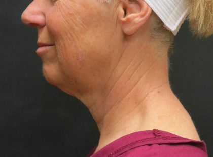 Neck Lift Before & After Patient #2697