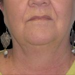 Neck Lift Before & After Patient #2704