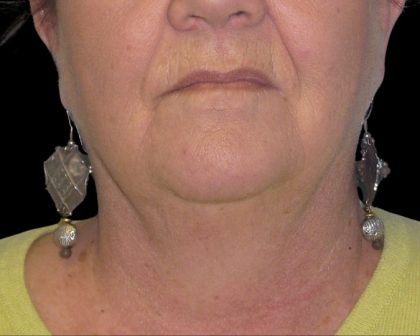 Neck Lift Before & After Patient #2704