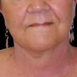 Neck Lift Before & After Patient #2704