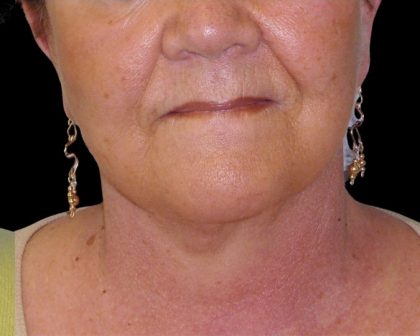 Neck Lift Before & After Patient #2704