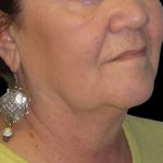 Neck Lift Before & After Patient #2704
