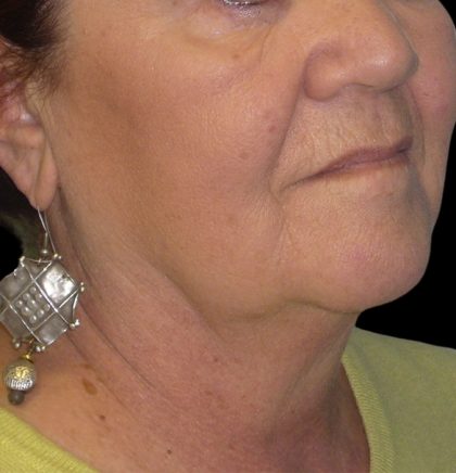 Neck Lift Before & After Patient #2704