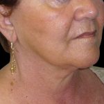 Neck Lift Before & After Patient #2704