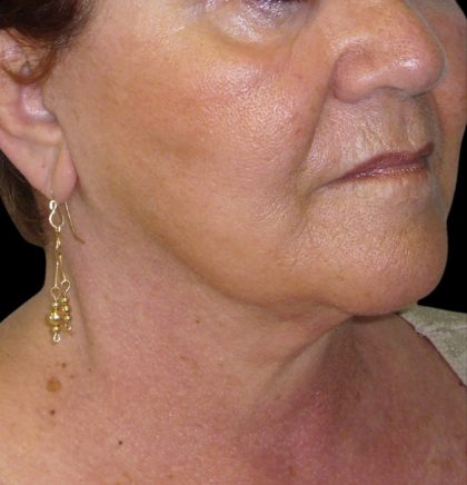 Neck Lift Before & After Patient #2704