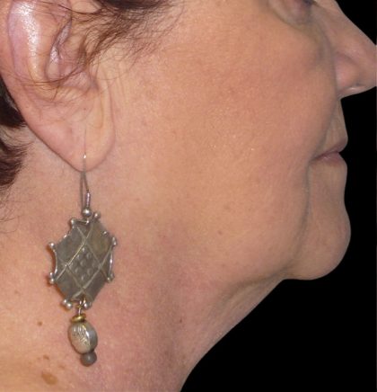 Neck Lift Before & After Patient #2704