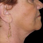 Neck Lift Before & After Patient #2704