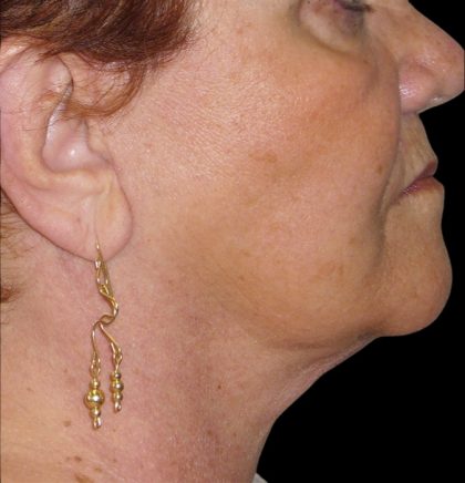 Neck Lift Before & After Patient #2704