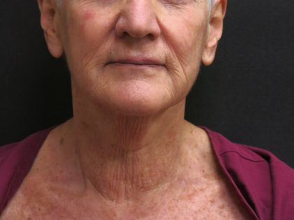 Neck Lift Before & After Patient #2715