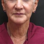 Neck Lift Before & After Patient #2715