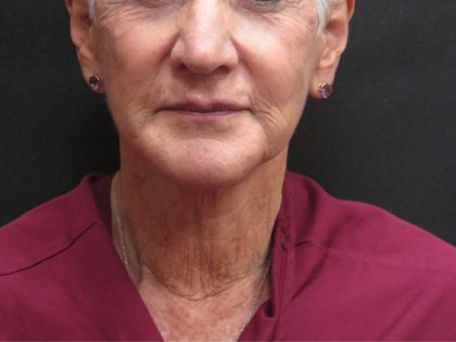 Neck Lift Before & After Patient #2715