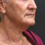 Neck Lift Before & After Patient #2715