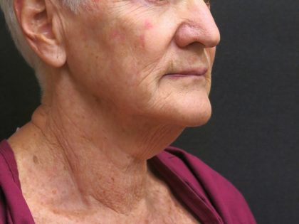 Neck Lift Before & After Patient #2715