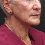 Neck Lift Before & After Patient #2715