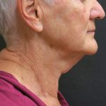 Neck Lift Before & After Patient #2715