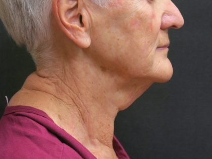 Neck Lift Before & After Patient #2715