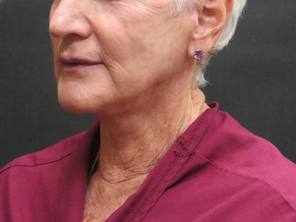 Neck Lift Before & After Patient #2715