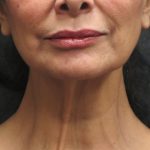Neck Lift Before & After Patient #2726