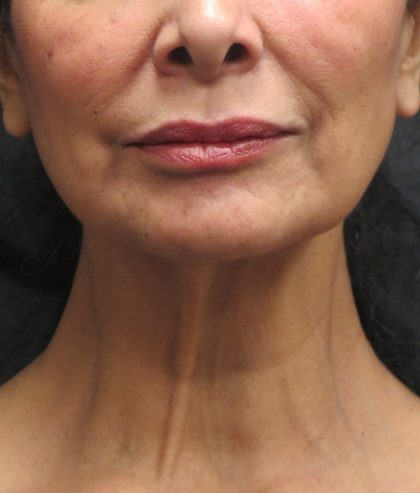 Neck Lift Before & After Patient #2726