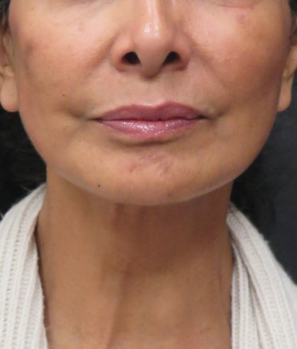 Neck Lift Before & After Patient #2726