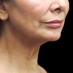 Neck Lift Before & After Patient #2726