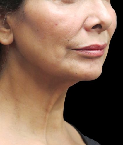 Neck Lift Before & After Patient #2726