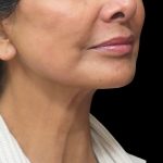 Neck Lift Before & After Patient #2726
