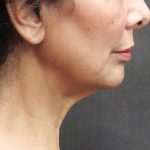 Neck Lift Before & After Patient #2726