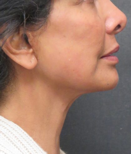 Neck Lift Before & After Patient #2726