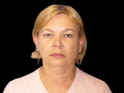 Neck Lift Before & After Patient #2733
