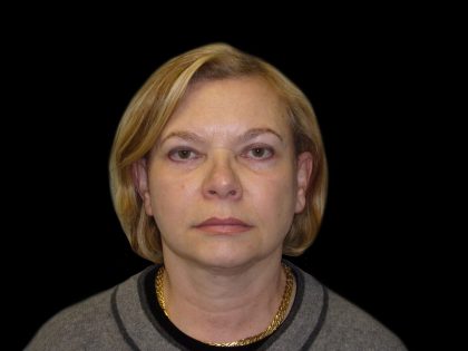 Neck Lift Before & After Patient #2733