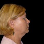 Neck Lift Before & After Patient #2733