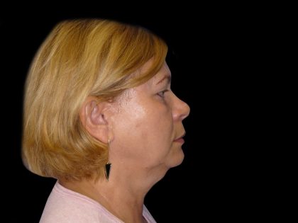 Neck Lift Before & After Patient #2733