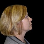 Neck Lift Before & After Patient #2733