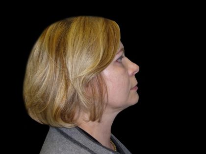 Neck Lift Before & After Patient #2733